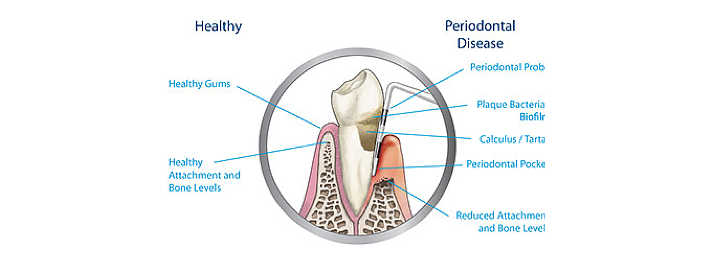 Dental Root Plaining and Scaling