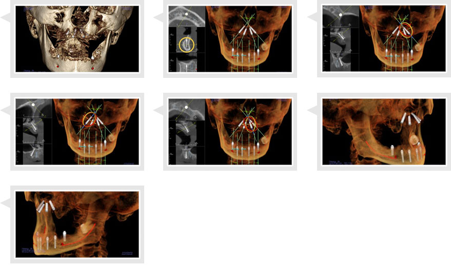 Virtual Surgery Planning stage of Patient A January 2014