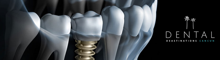 Single dental implant - treatments