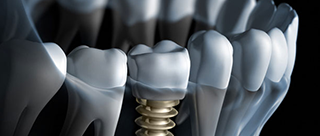 Single dental implant - treatments